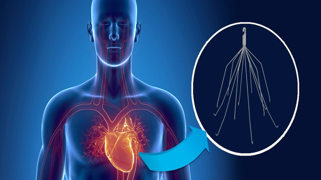 IVC Filter Failures - Safety Watch