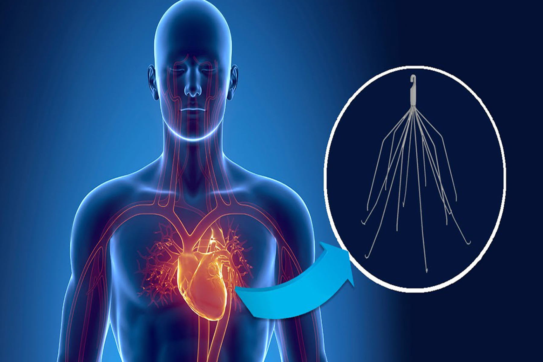 Кава фильтр. Имплантация кава-фильтра. Inferior Vena Cava Filter.